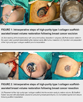 Breast Cancer Excision Repair and Reconstruction